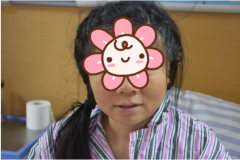 种植牙后变大饼脸,竟然怪鼻子惹了祸?