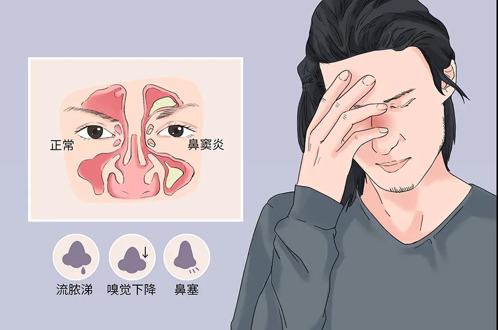 成都治疗鼻窦炎医院