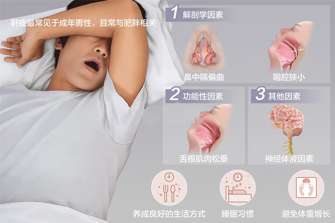 成都睡觉打鼾该怎么办?